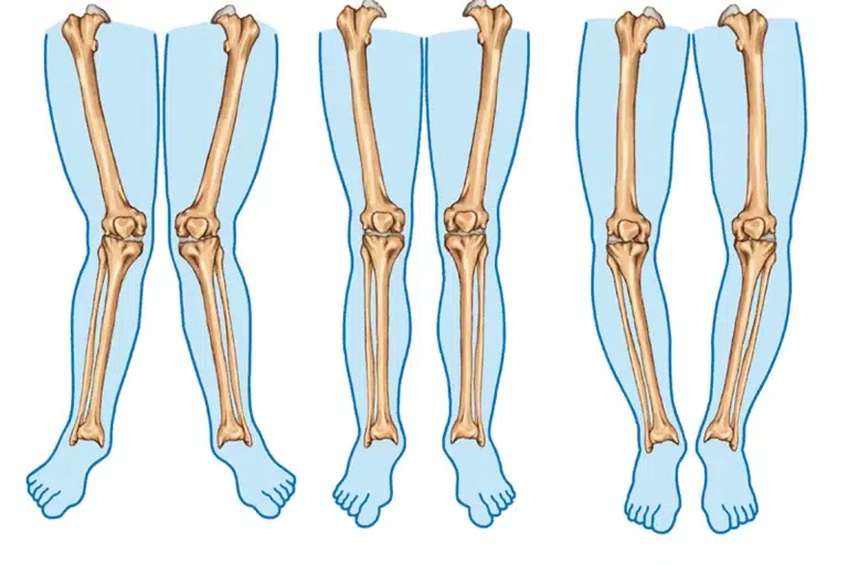 Osteotomia do Joelho