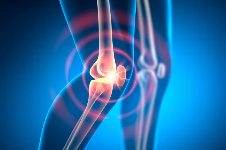 Patellar Chondropathy