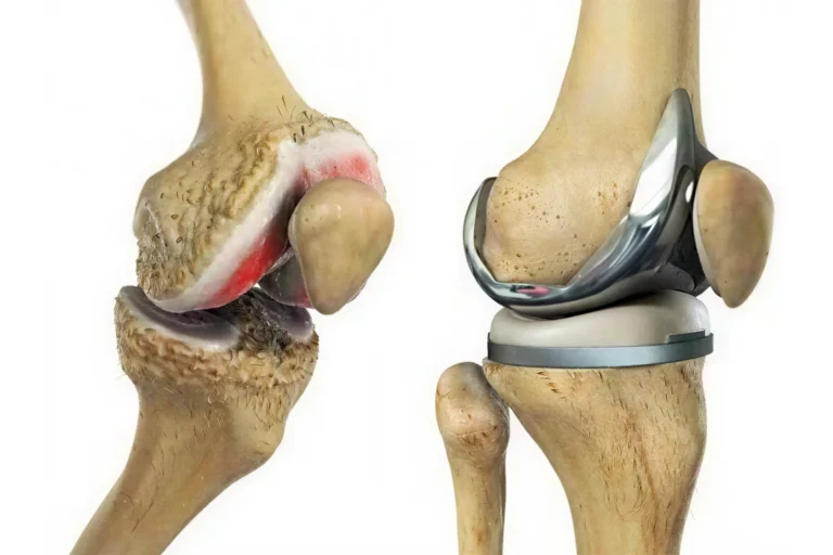 Artroplastia Moderna de Joelho